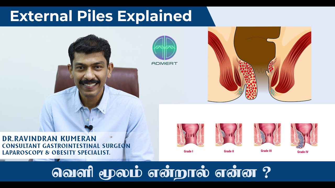 External Piles Explained | வெளி மூலம் என்றால் என்ன ? | Dr.Ravindran Kumeran | Tamil Medical Tips