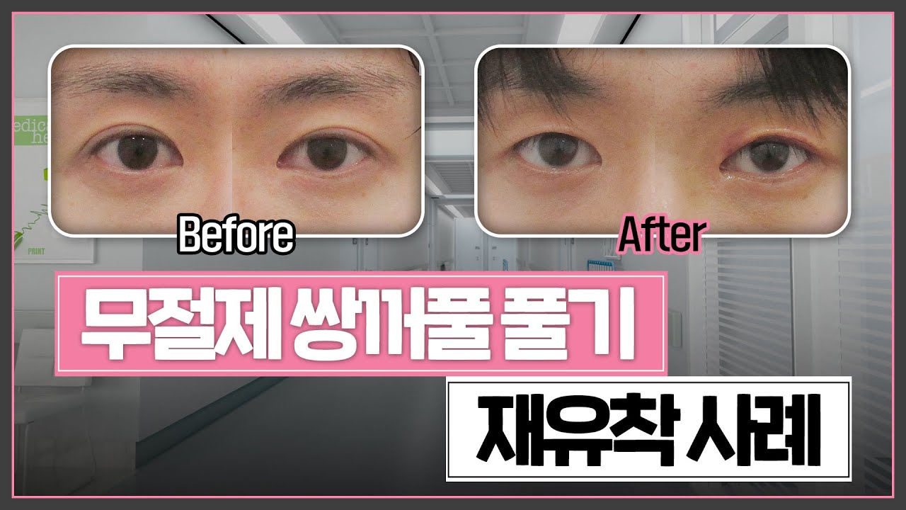무절제 쌍꺼풀 풀기 후 재유착? ⭐이렇게⭐ 해결합니다! (Feat. 쌍꺼풀 제거 · 두줄따기 고민한다면 필수 시청!)