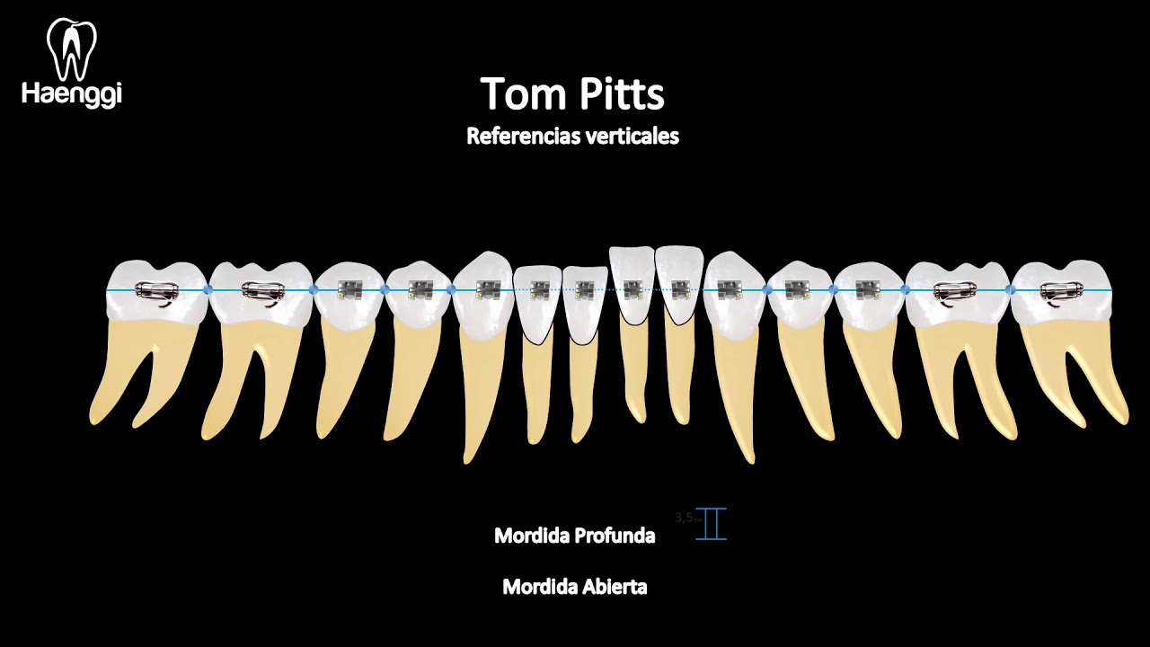 Posicionamiento SAP Brackets.