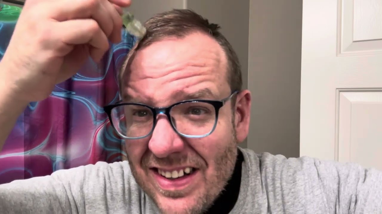 From Bald to Bold: Using Alphainfuse for a month - SCAM or LEGIT