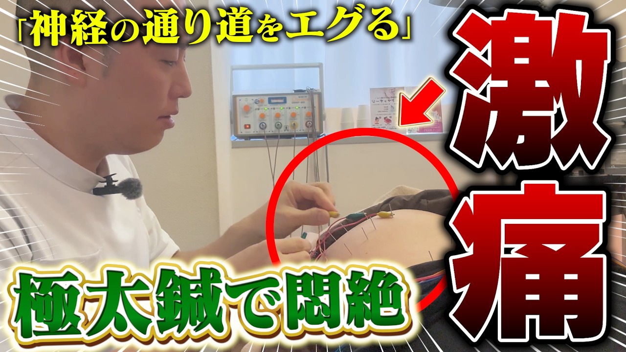 【腰椎ヘルニア】ロキソニンが効かない痛み｜鍼で神経をエグった結果…