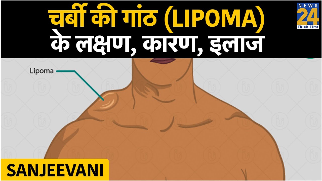 Sanjeevani: चर्बी की गांठ (Lipoma) के लक्षण, कारण, इलाज