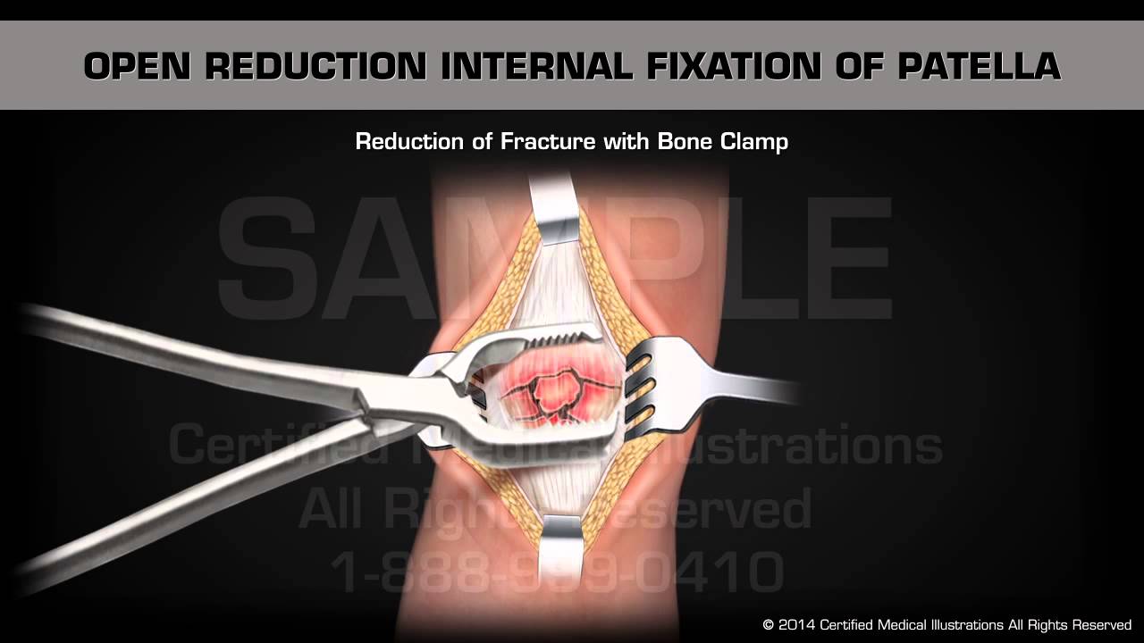 Open Reduction Internal Fixation of Patella
