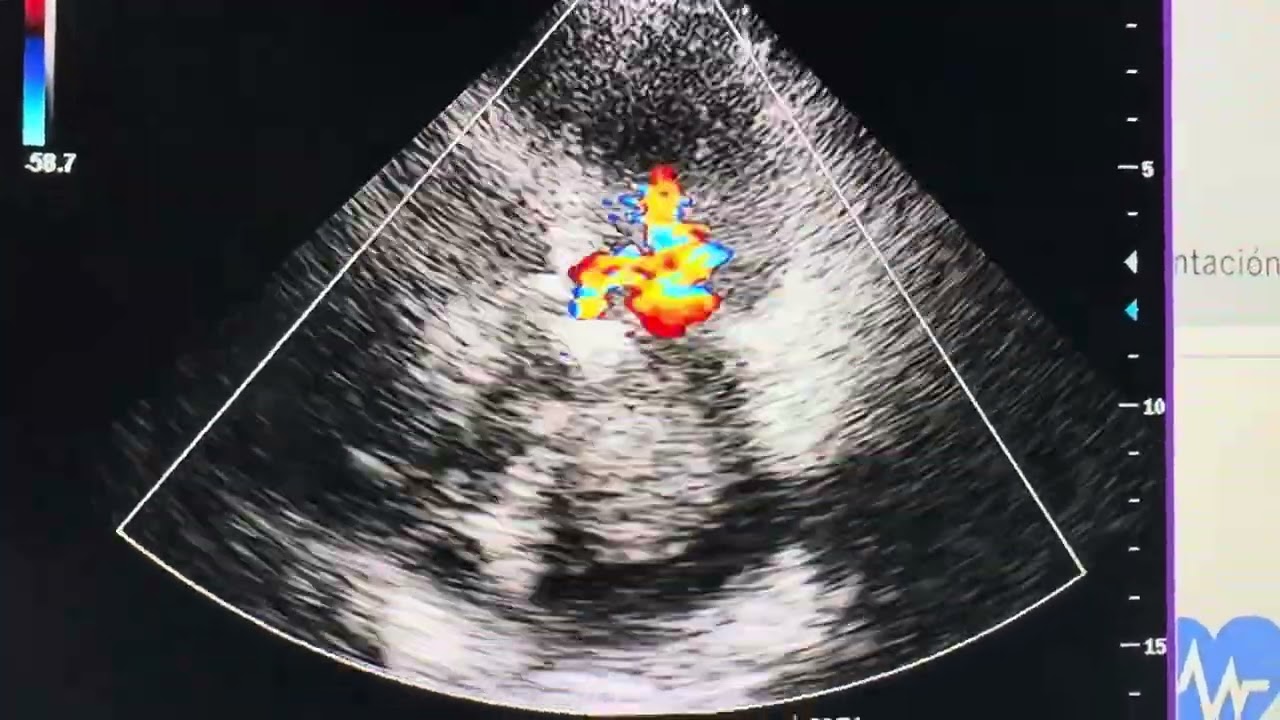 CardioScience: Tumor Cardíaco Mixoma, Cardiopatía Reumática Mitro-Aórtica e Infarto al miocardio