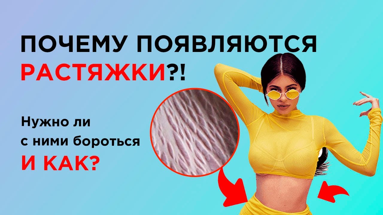 Растяжки на коже: Кайли Дженнер, Леди Гага и другие знаменитости, которые не стесняются