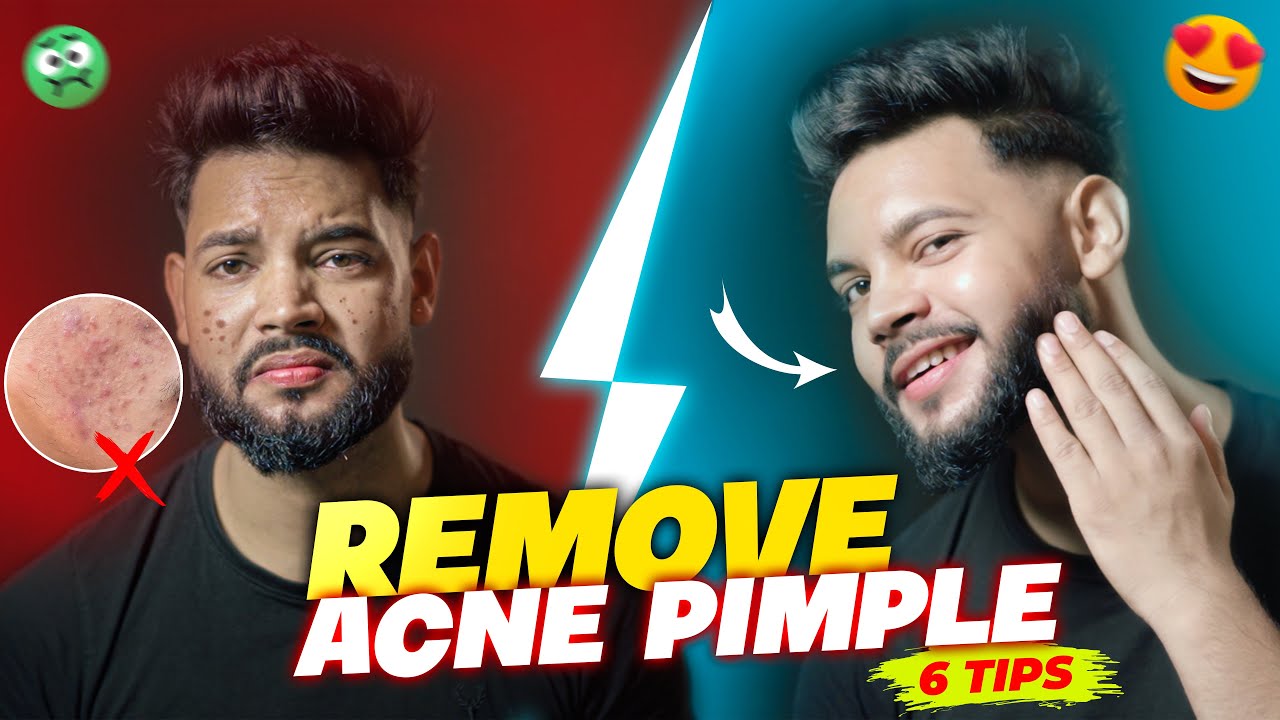 Skin Care Routine For Acne Pimple Prone Skin | REMOVE ACNE/PIMPLES