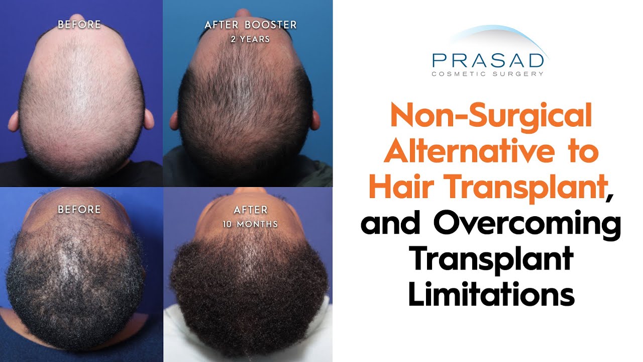 How a Non-Surgical Hair Transplant Alternative can Overcome Limitations of Hair Transplants