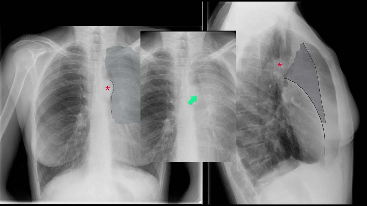 Left Upper Lobe Collapse