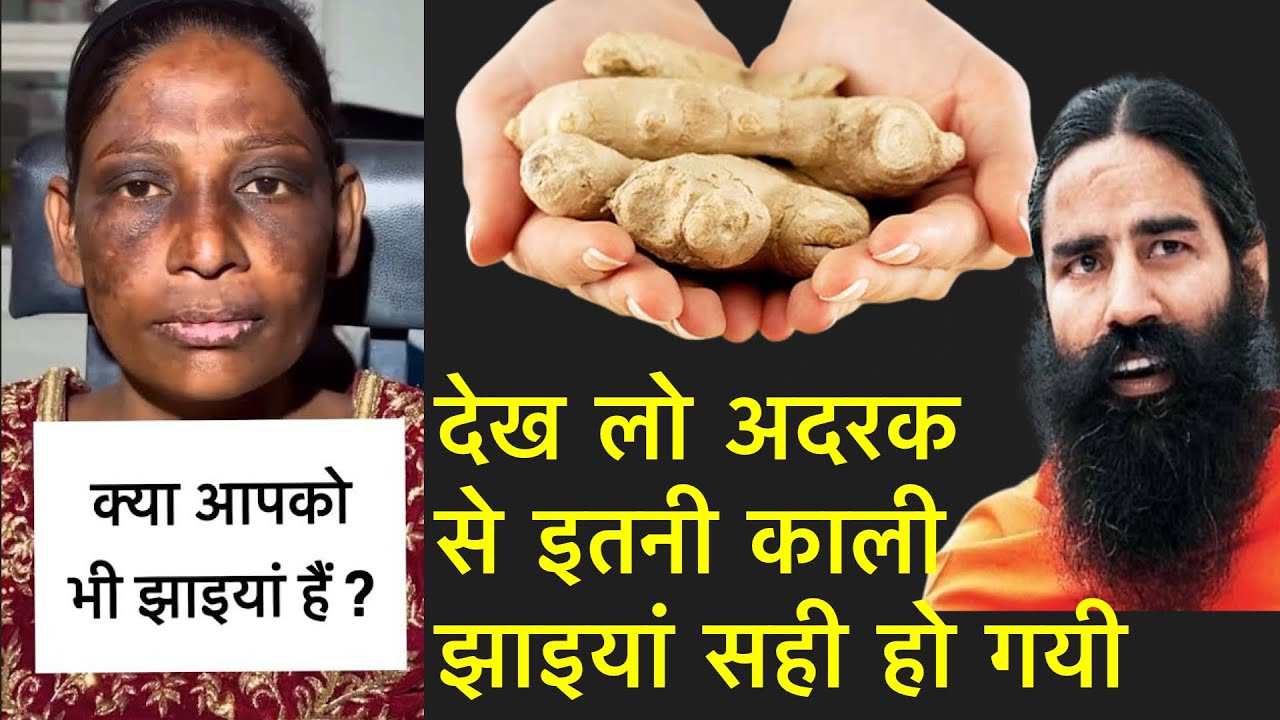 अदरक से झाइयां हटाने का कमाल का तरीका Reduce Melasma, Pigmentation, Discolouration Blackspots part-2