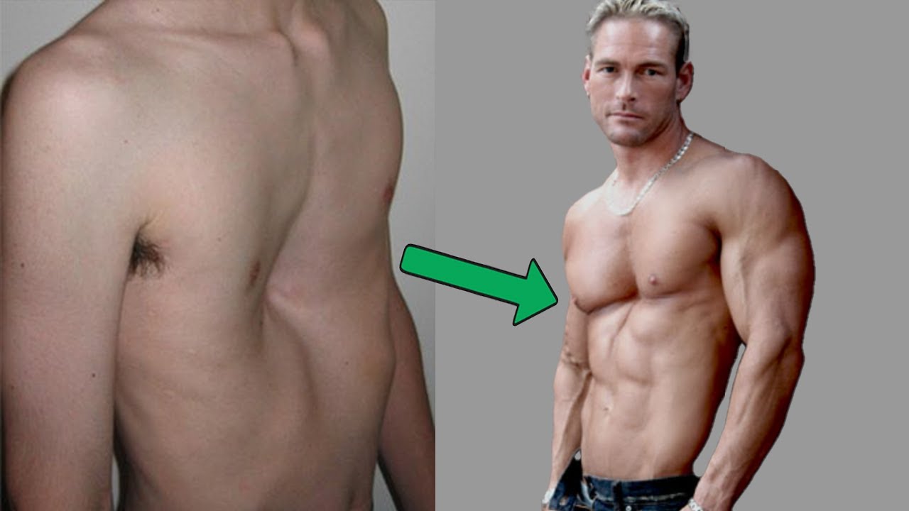 Экскавация грудной клетки Бодибилдинг