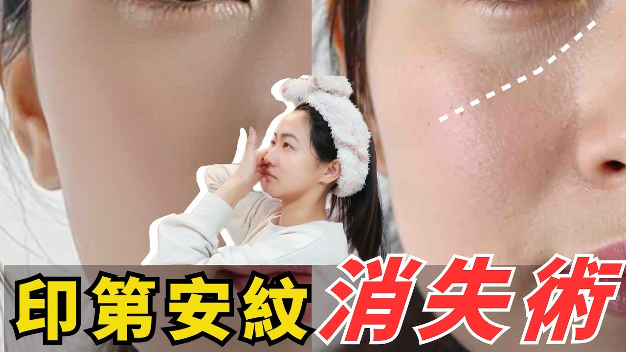 3分鐘淡化印第安紋，臉皮筋肉提拉術｜重現緊緻線條！