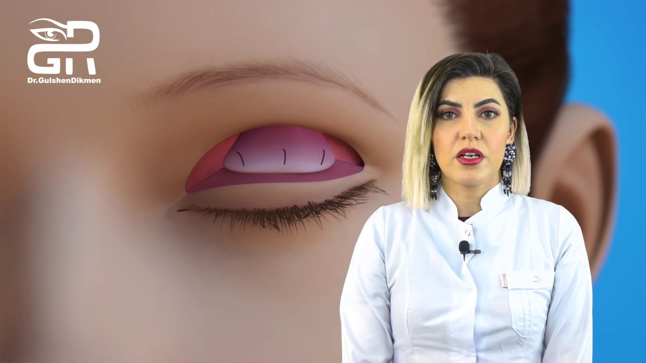 Ptosis Göz qapağı sallanması - Oftalmoloq - Dr. Gülşən Dikmen