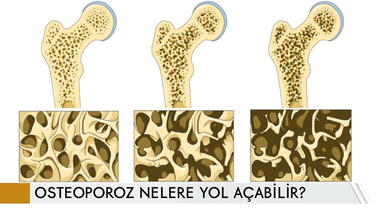 Osteoporoz nelere yol açabilir? | Prof. Dr. Yakup YILDIRIM