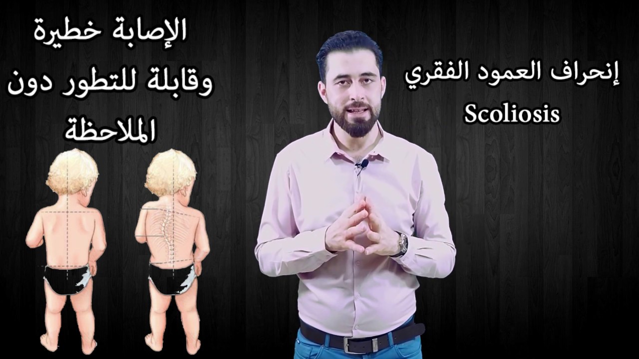 الجنف او إنحراف العمود الفقري (( هل تريد حماية إبنك من الجراجة ؟؟؟؟