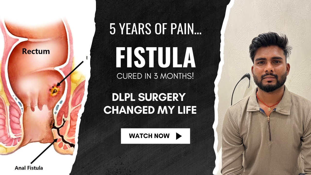 From UP to Pune: Fistula Cured in 3 Months with DLPL Surgery by Dr. Ashwin Porwal
