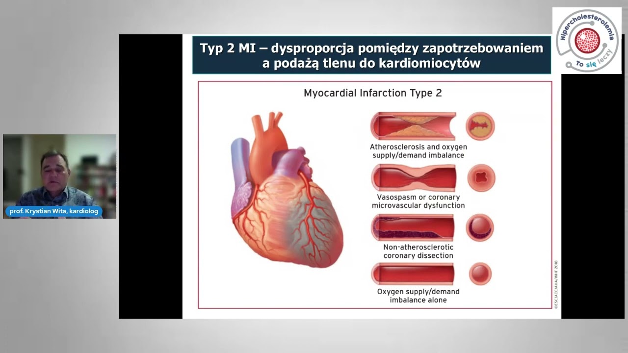 Jak uniknąć kolejnego zawału  - skuteczna kontrola i leczenie hipercholesterolemii
