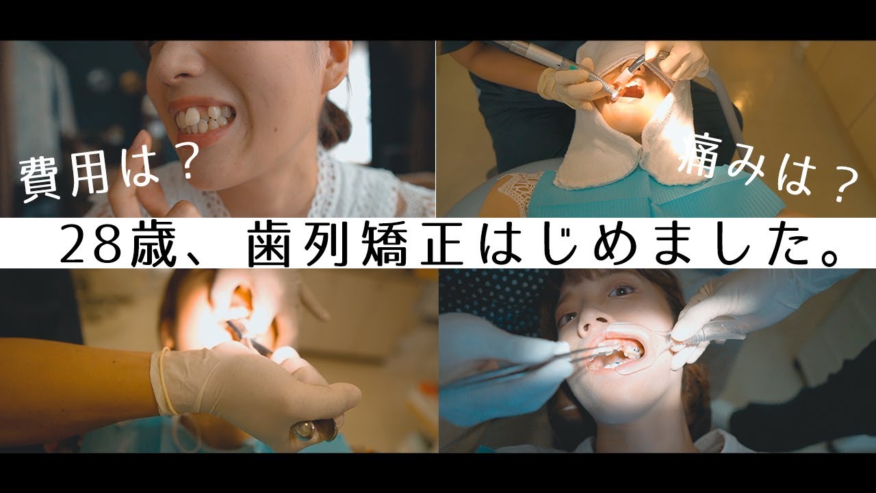 【歯列矯正#1】ついに歯列矯正始めたので費用や痛みを解説します【ワイヤー矯正】