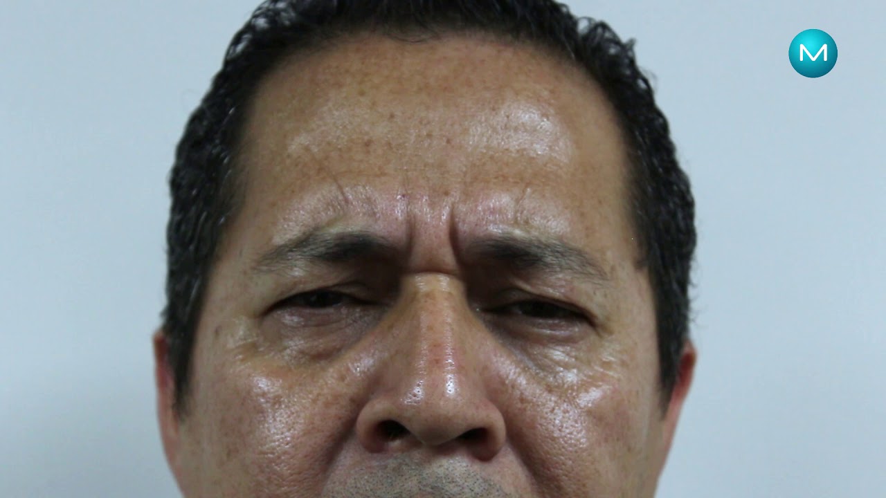 Me apliqué Botox® hace días, ¿Por qué aun no me hace efecto?