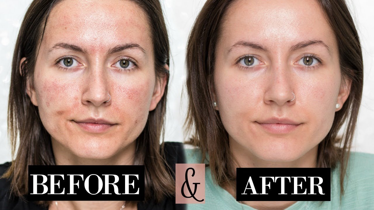 Мой опыт MICRONEEDLING | + Обновления кожи | До и после