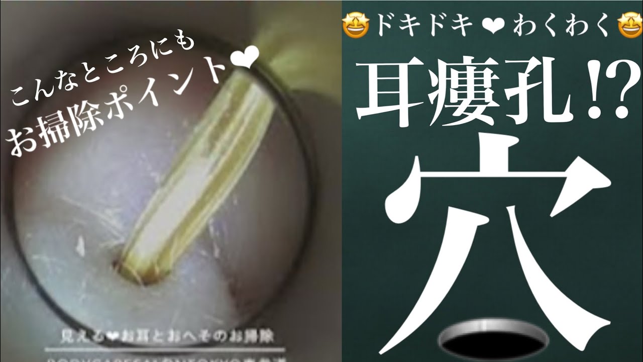142 #耳掃除 #耳かき #earwax【#耳瘻孔 発見！すぽっとポイント、何回かあります】