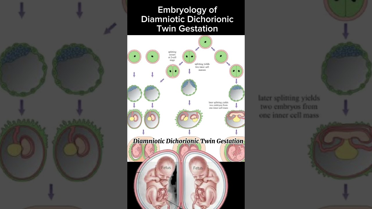 Embryology of Diamniotic Dichorionic Twin Gestation #shortsbeta #doctors #health @Dr.SaimaKhan