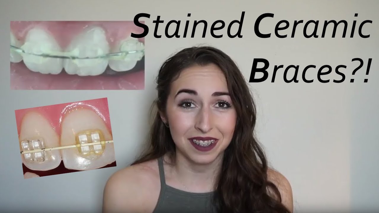 STAINS IN CERAMIC BRACES?? Ways to clean them! //Wk.2 Vlog | Adult Braces to Treat TMJ/TMD