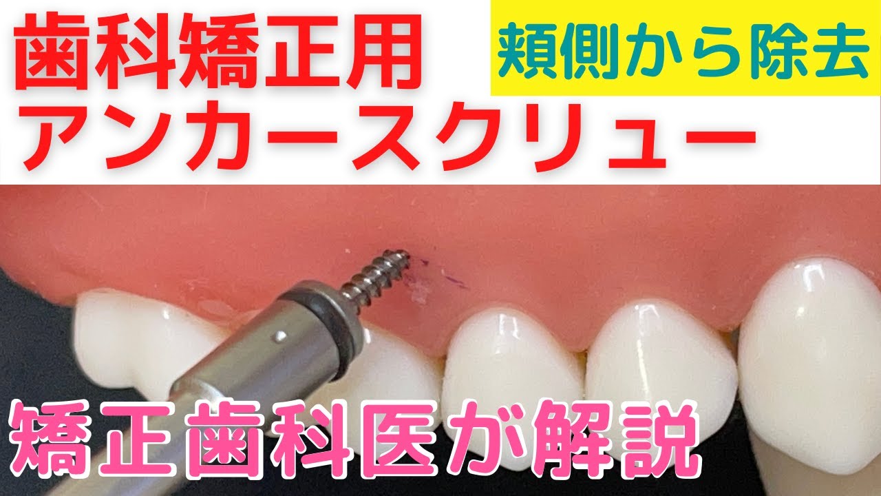 【アンカースクリューの除去　頬側】模型で矯正歯科医が解説　How to remove orthodontic anchor screw