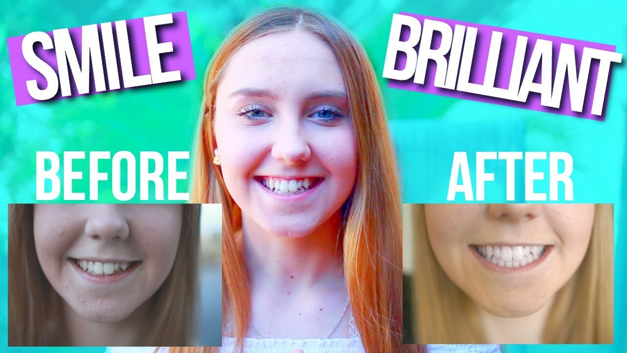How To Get White Teeth FAST | Smile Brilliant