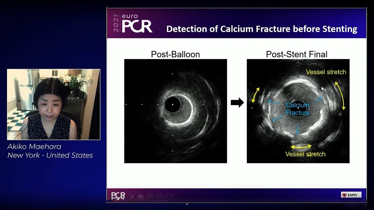Complex PCI in coronary calcified lesions, the right tools and techniques - EuroPCR 2021
