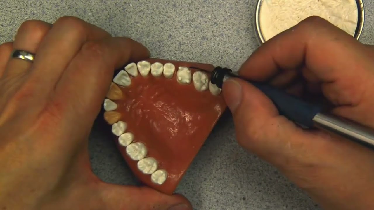 Simple Waxup of Maxillary Left First Molar, #14
