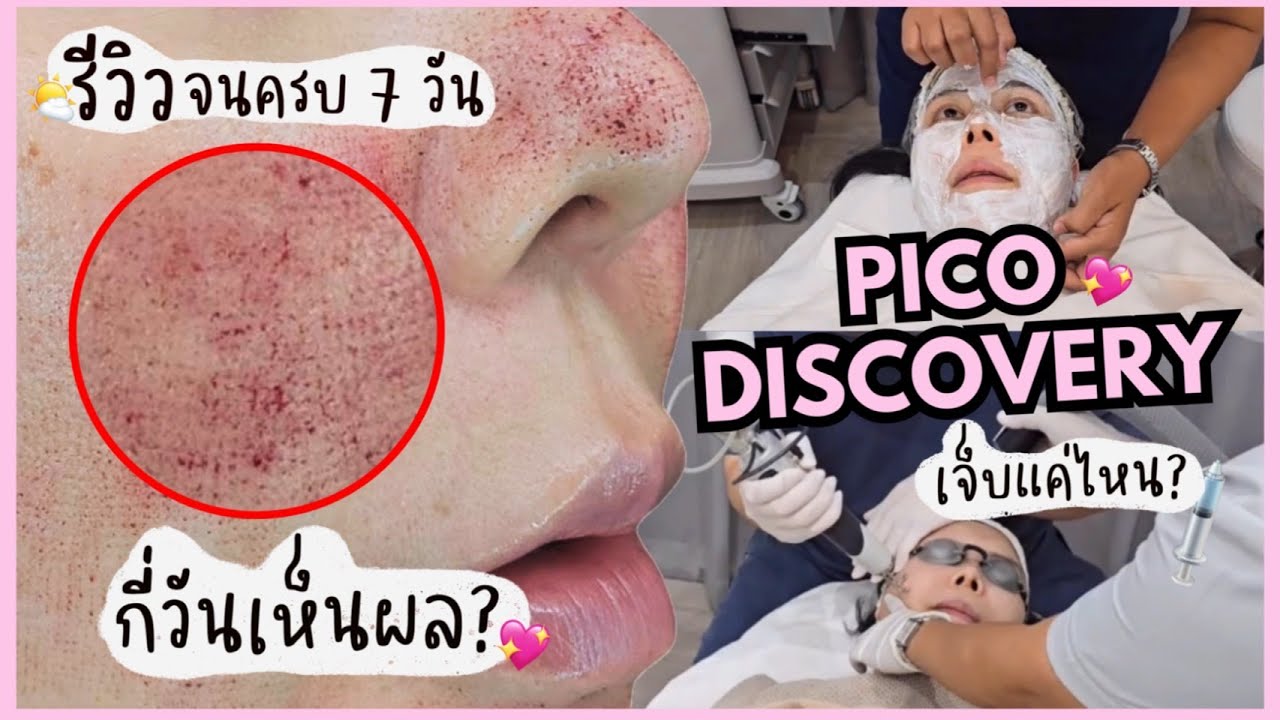 รีวิวการทำ Pico Laser Discovery ติดตามผลครบ 7 วัน | NUUNA makeup
