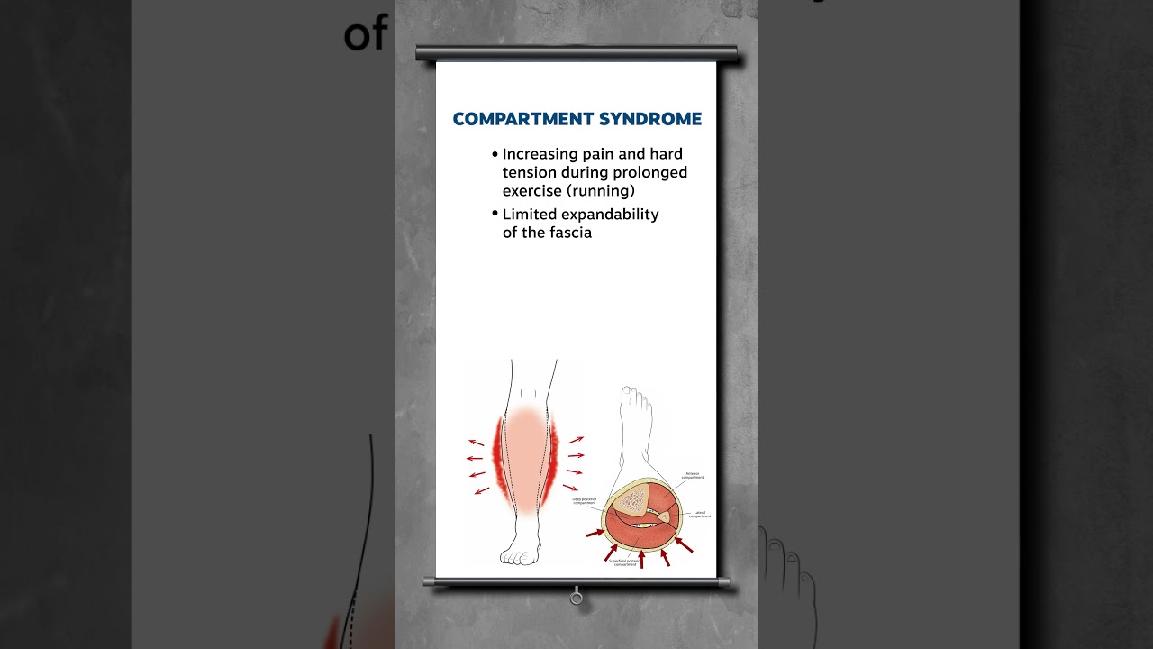 Compartment syndrome explained