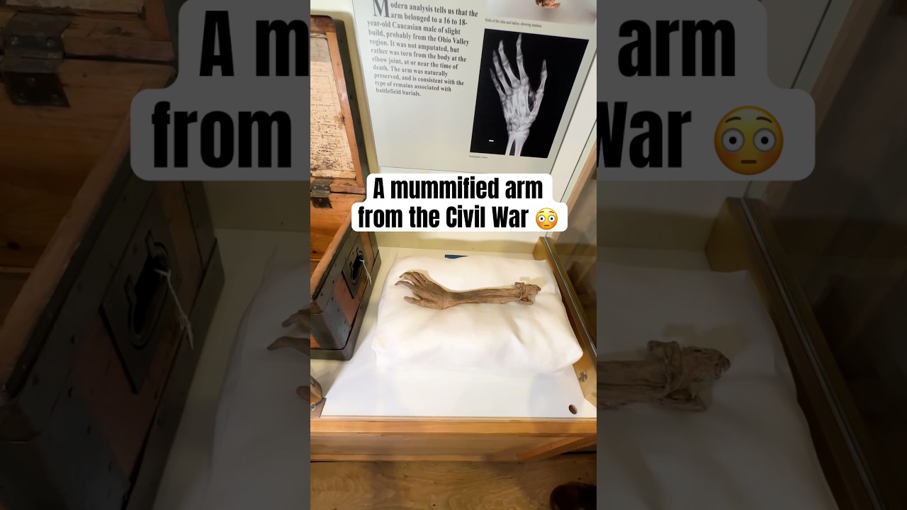 A mummified arm from the Civil War
