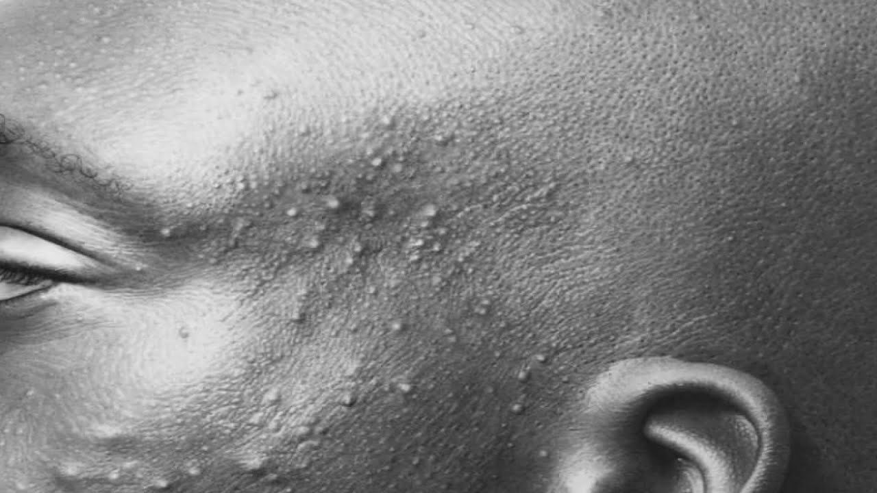 How to draw Pimples (Acne) - FOR BEGINNERS