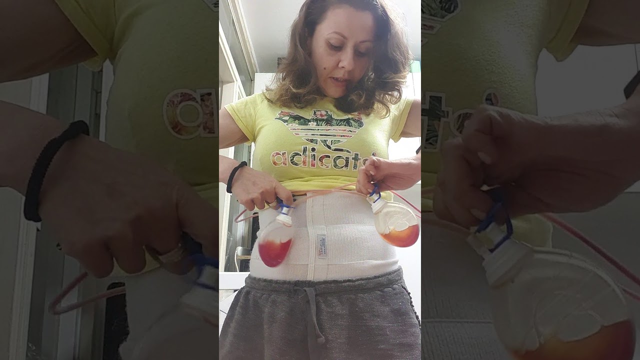 Абдоминопластика 9тый день