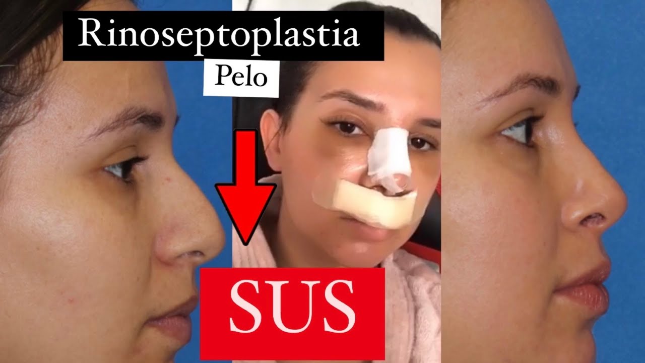MINHA RINOSEPTOPLASTIA PELO SUS | EXPLICO TUDO NO VÍDEO E MOSTRO CADA DETALHE | Jady Mirelle