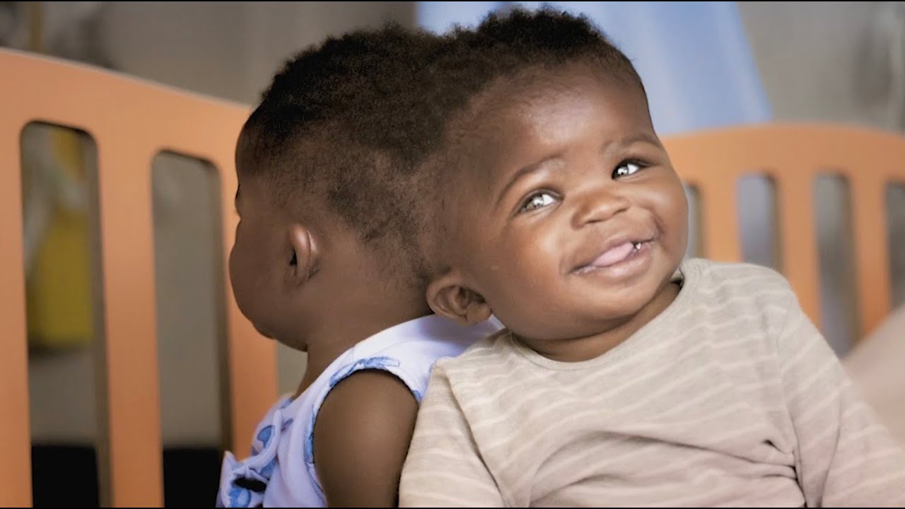 Two conjoined twins separated successfully in Italy