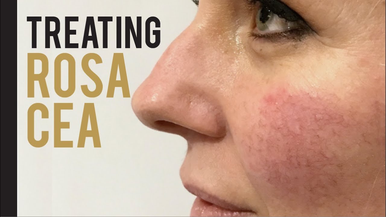 How this Make Up Artist Got Rid of Her Rosacea