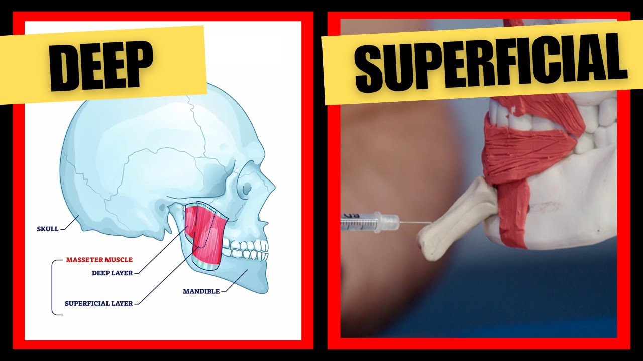 The Best Lower Face Botox Injection Depths  | Botox Injection Depth Guide