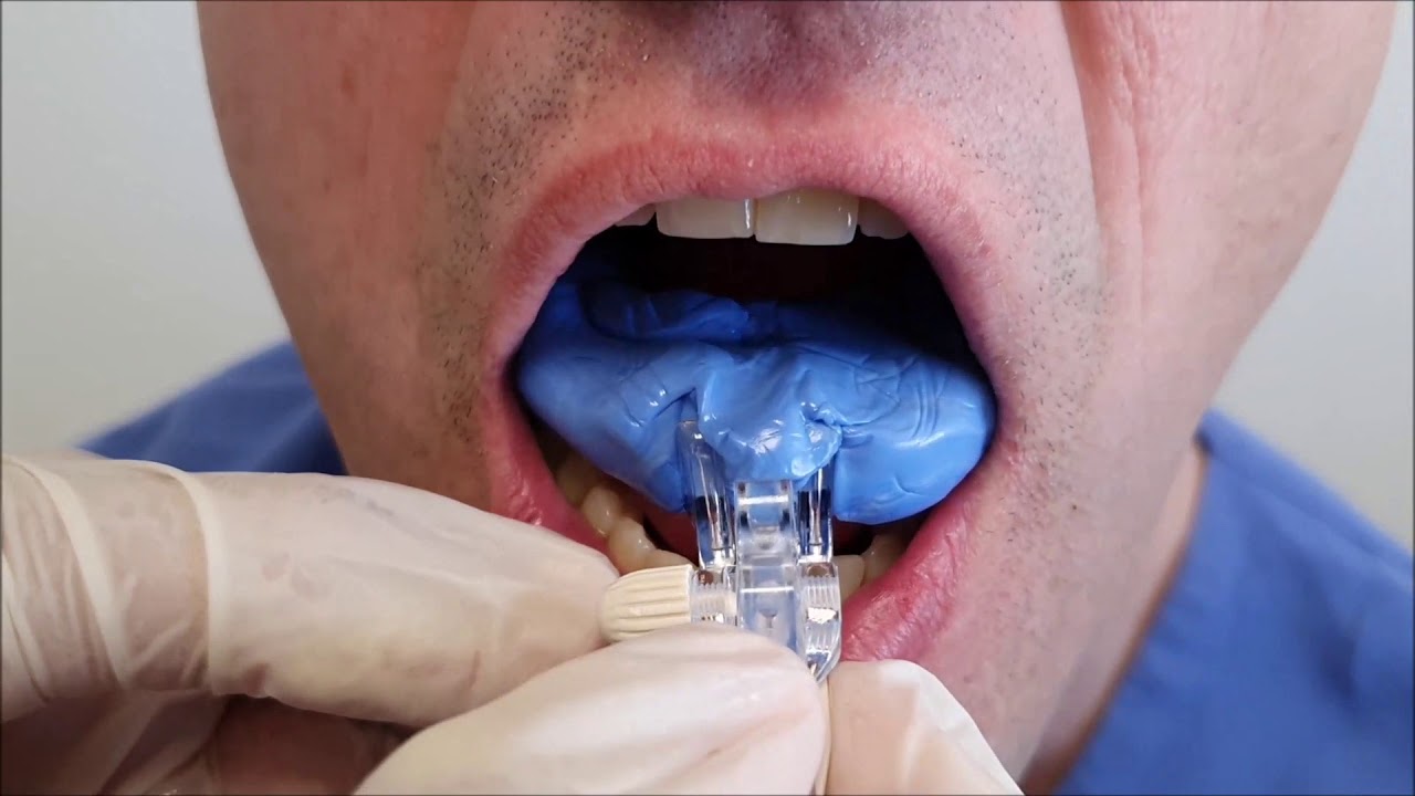 Utilisation d'une fourchette d'occlusion (GeorgeGauge ou SomGauge)