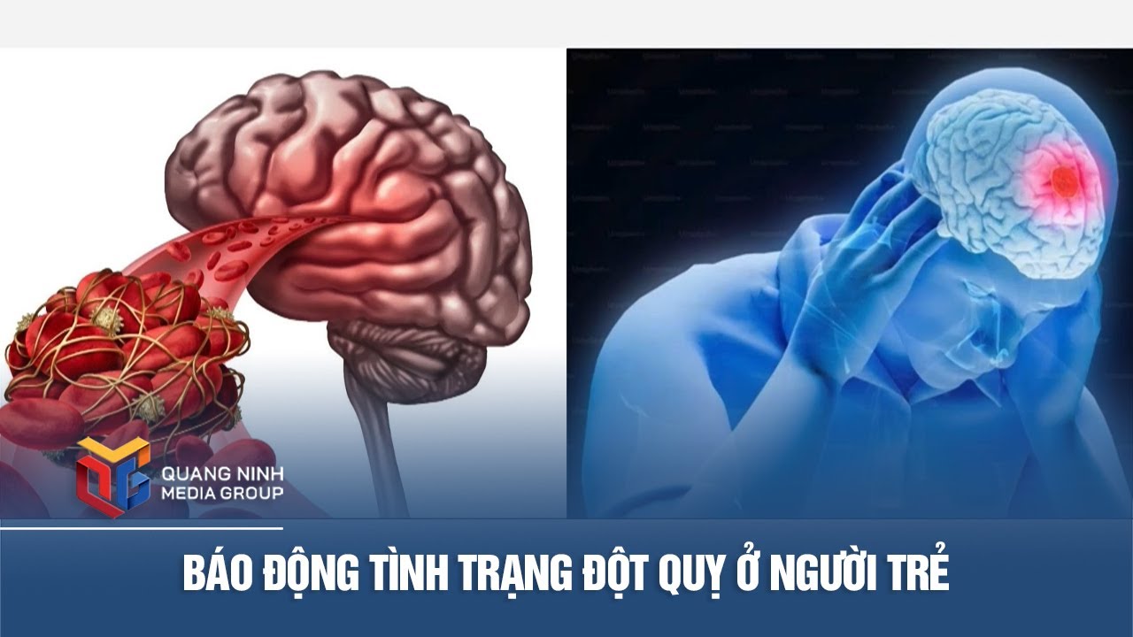Báo động tình trạng đột quỵ ở người trẻ