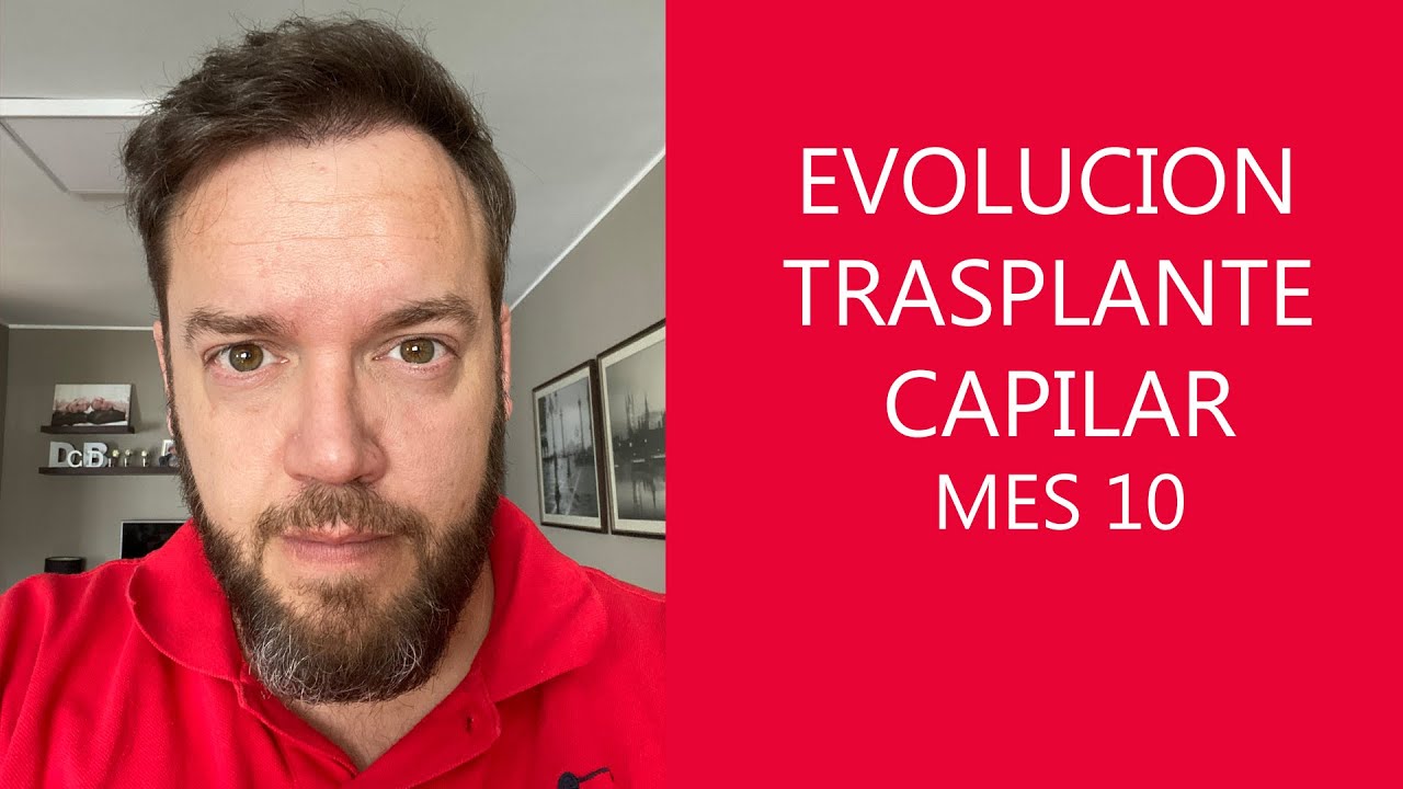Evolución Trasplante capilar en Turquía - 10 meses