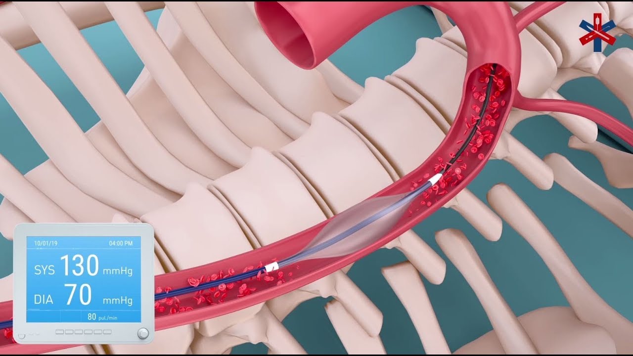 The EVTM REBOA Catheter Demonstration Video