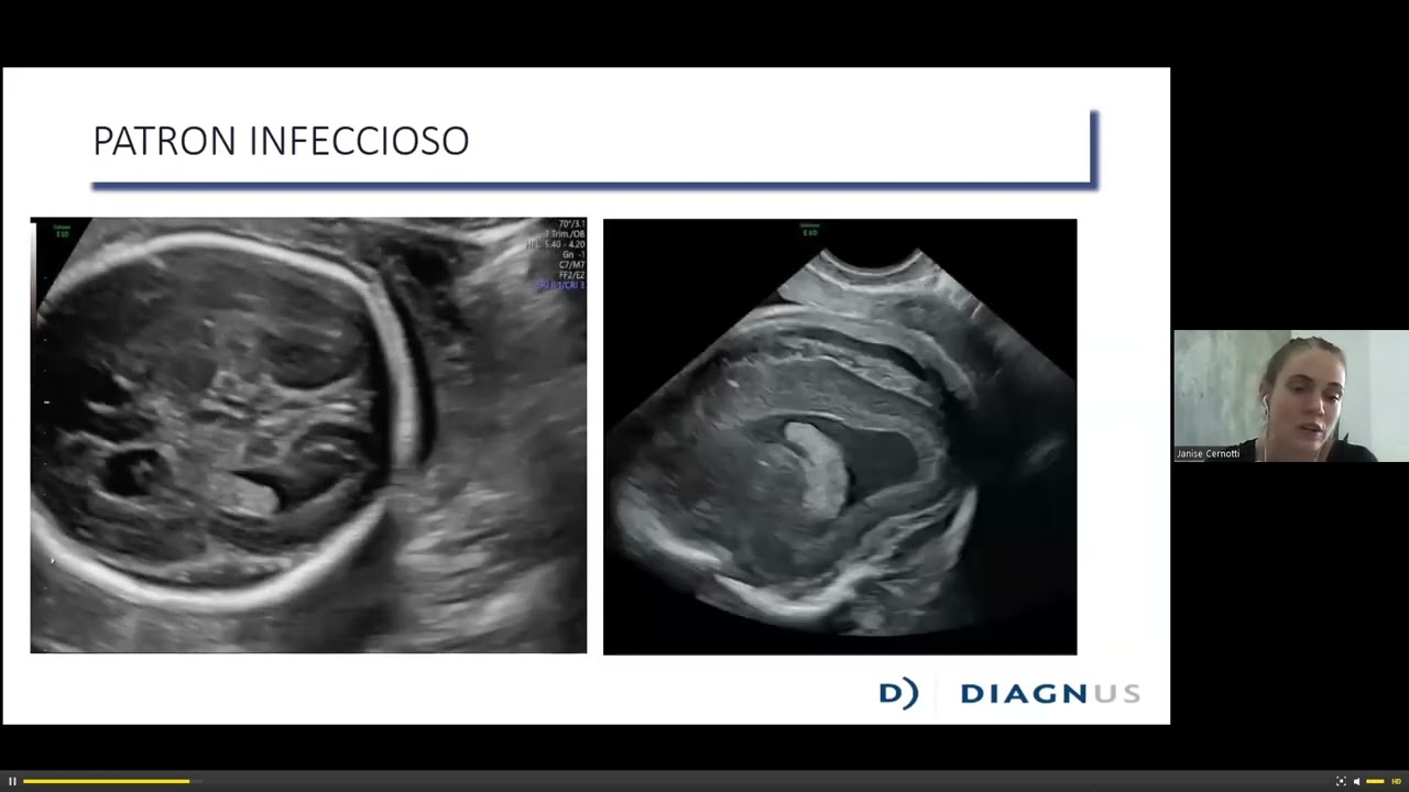 VENTRICULOMEGALIA CEREBRAL FETAL