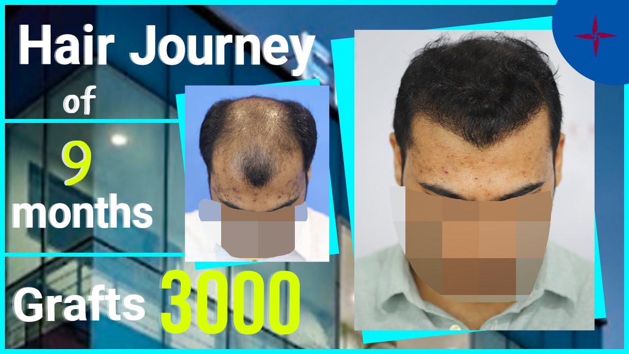 Hair Transplantation Result in 9 Months, 3000 Grafts, Grade 6 @Eugenix  by Drs Sethi & Bansal