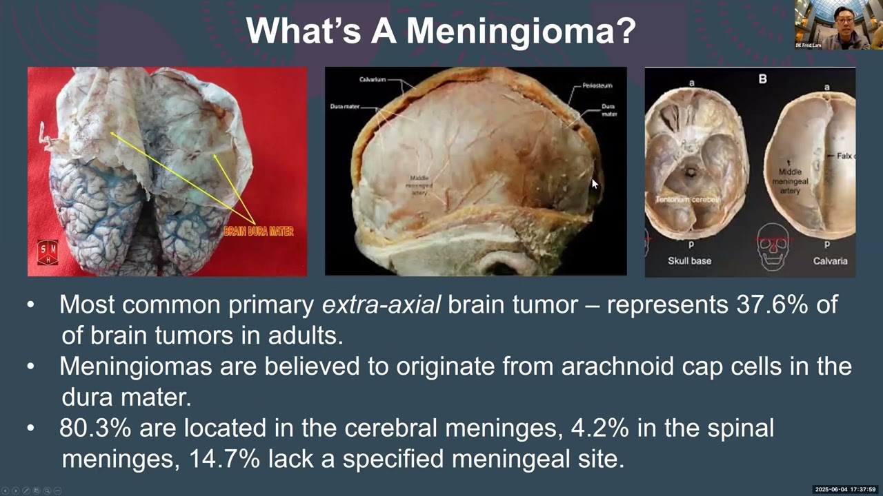 Current Research & Clinical Trials Updates for the Treatment of Patients with Meningiomas