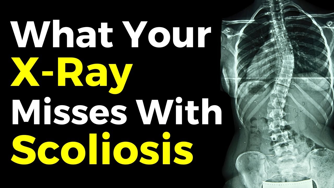 Cobb Angle vs Rotation in Scoliosis: Why It Matters
