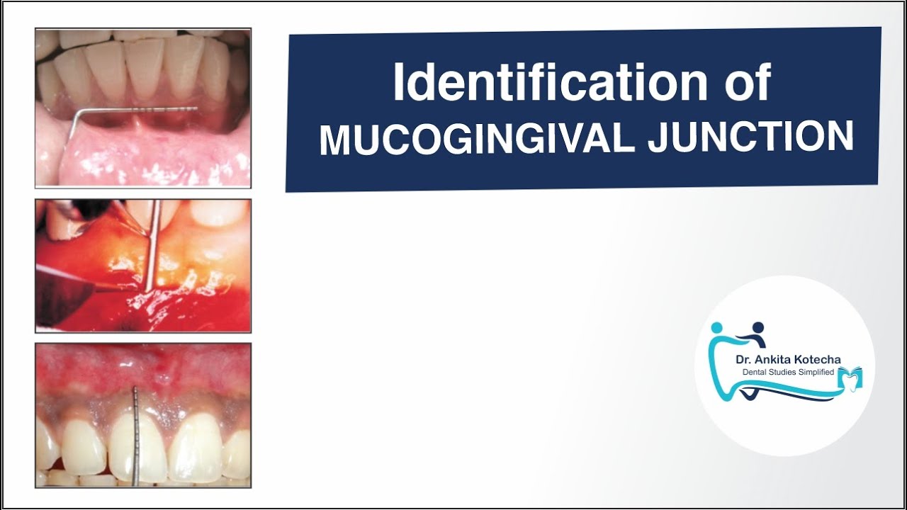 Identification of MUCOGINGIVAL JUNCTION/VISUAL METHOD/STAINING METHOD/ROLL TEST/LA (ANESTHESIA) TEST