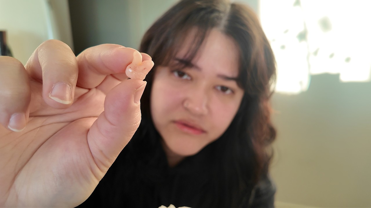 I kept the tooth! I have no regrets 🦷 (wisdom tooth removal vlog)