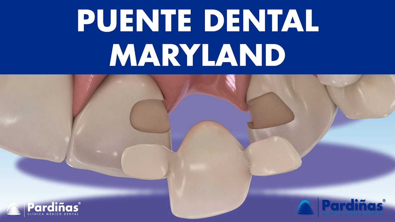Puente MARYLAND - Una alternativa de PUENTE DENTAL para los dientes faltantes &copy;